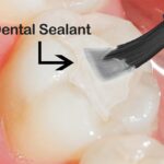 shows where dental sealant put on a tooth