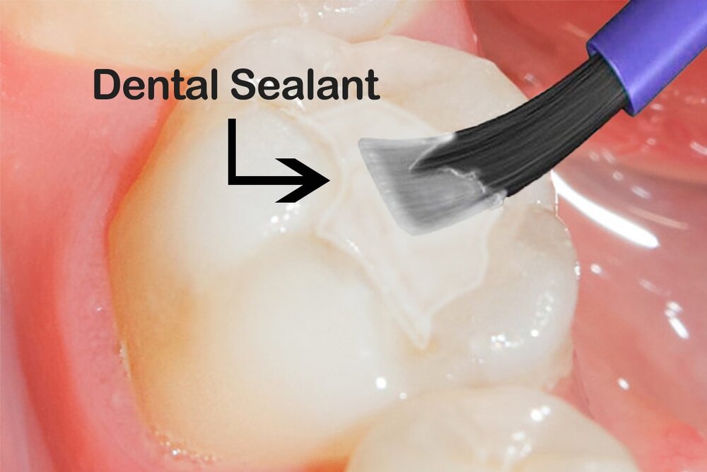 What are cavity-fighting sealants? - Dentist Salem MA
